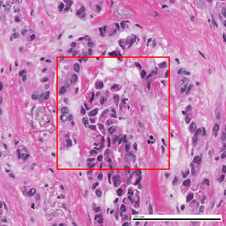 Illustrative H&E patch used for subtype analysis
