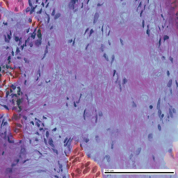 Model-generated tumour and stroma overlay on the same field